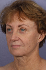 Facelift Before and after photo