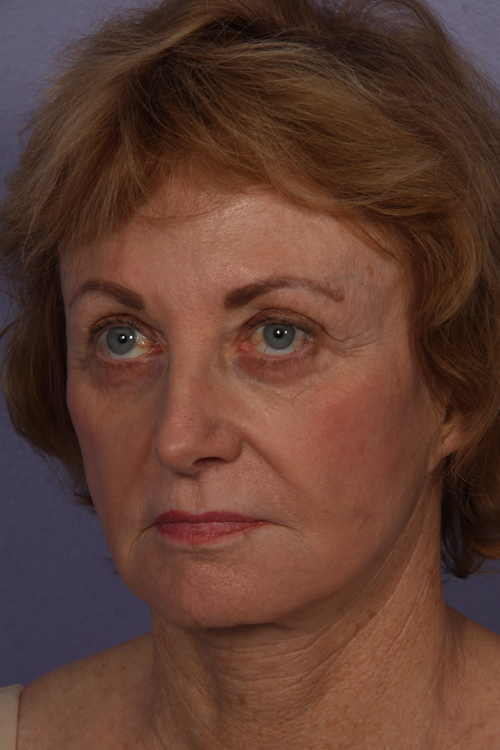 Facelift before and after photo