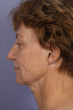 Facelift Before and after photo