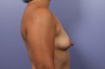 Breast Augmentation Before and after photo