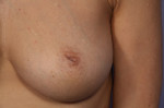 Nipple - Inversion Correction Before and after photo