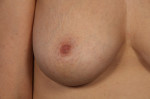 Nipple - Inversion Correction Before and after photo