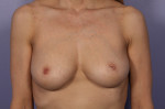 Nipple - Inversion Correction Before and after photo