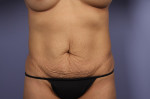 Tummy Tuck Before and after photo