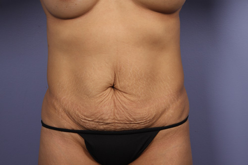 Tummy Tuck before and after photo