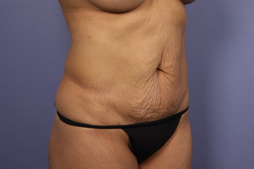 Tummy Tuck before and after photo