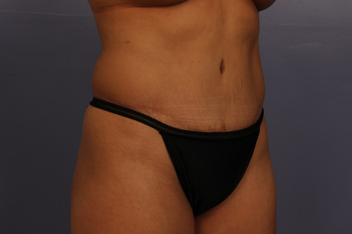 Tummy Tuck before and after photo