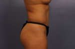 Tummy Tuck Before and after photo