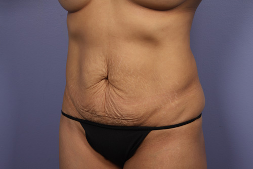 Tummy Tuck before and after photo