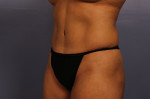 Tummy Tuck Before and after photo