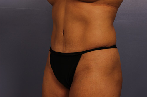 Tummy Tuck before and after photo