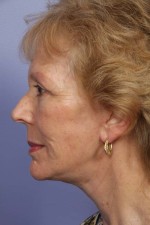 Facelift Before and after photo