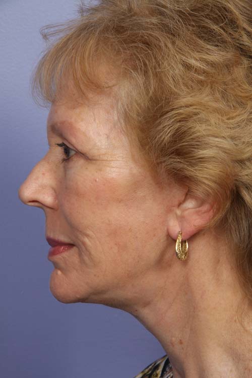 Facelift before and after photo