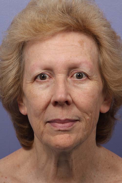 Facelift before and after photo