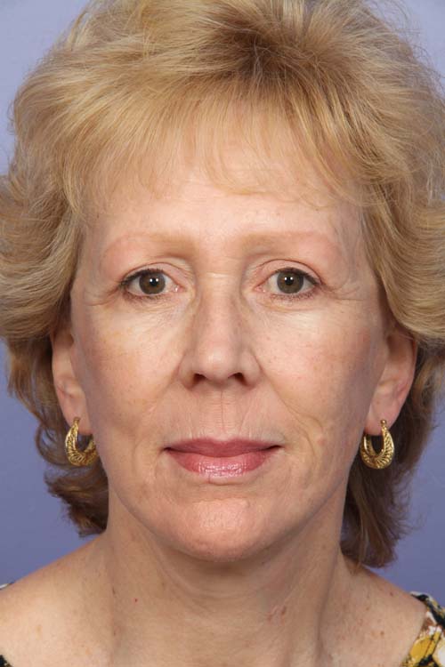 Facelift before and after photo