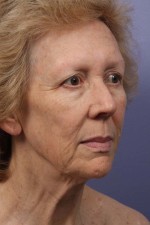 Facelift Before and after photo