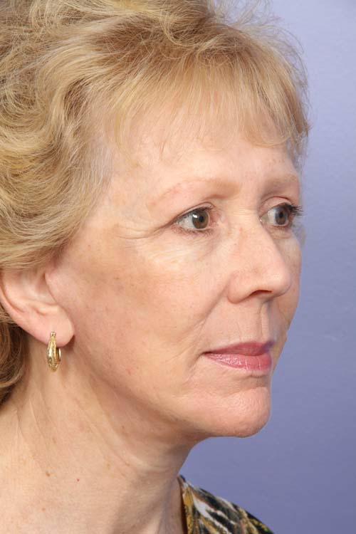 Facelift before and after photo