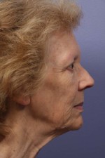 Facelift Before and after photo