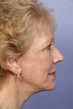 Facelift Before and after photo