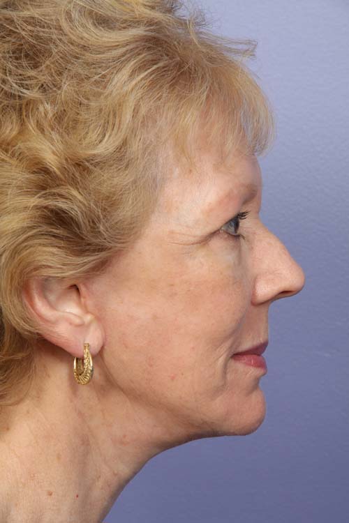 Facelift before and after photo