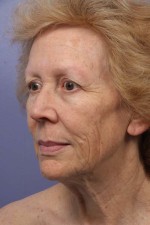 Facelift Before and after photo