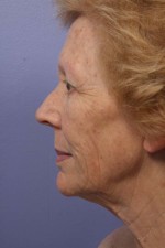 Facelift Before and after photo