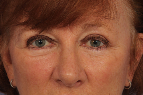 Eyelid Surgery before and after photo