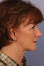 Eyelid Surgery Before and after photo