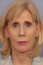 Facelift