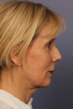 Facelift Before and after photo