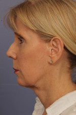 Facelift Before and after photo