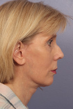 Facelift Before and after photo