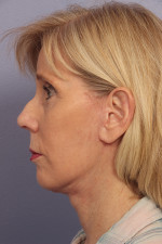 Facelift Before and after photo