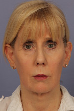 Facelift Before and after photo