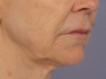 Injectable Fillers Before and after photo