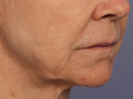 Injectable Fillers Before and after photo