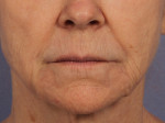 Injectable Fillers Before and after photo