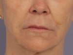 Injectable Fillers Before and after photo