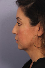 Ultherapy Before and after photo