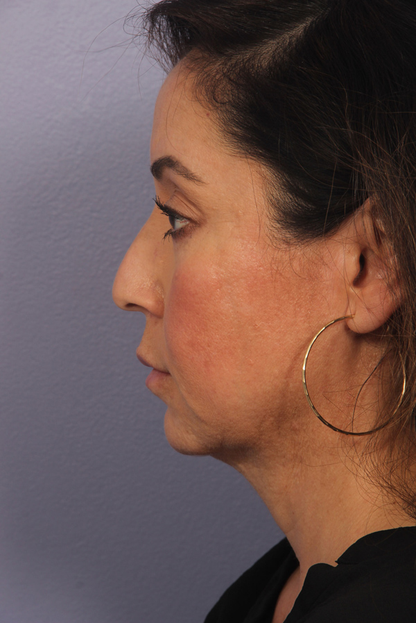 Ultherapy before and after photo