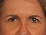 Injectable Fillers Before and after photo