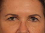 Injectable Fillers Before and after photo