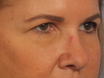 Injectable Fillers Before and after photo