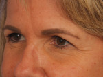 Injectable Fillers Before and after photo