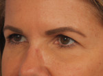 Injectable Fillers Before and after photo