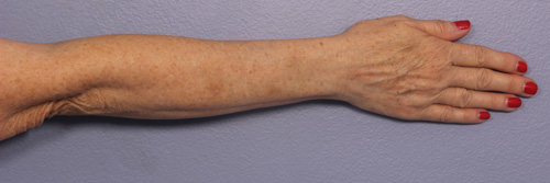 Laser Skin Resurfacing before and after photo