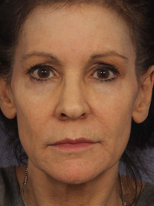 Injectable Fillers before and after photo