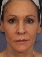 Injectable Fillers Before and after photo