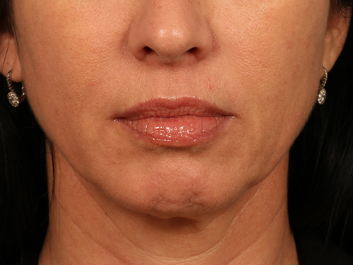 Injectable Fillers before and after photo