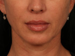 Injectable Fillers Before and after photo